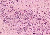 : : : : : : : : : : Avian encephalomyelitis, brain lesions, histopathology